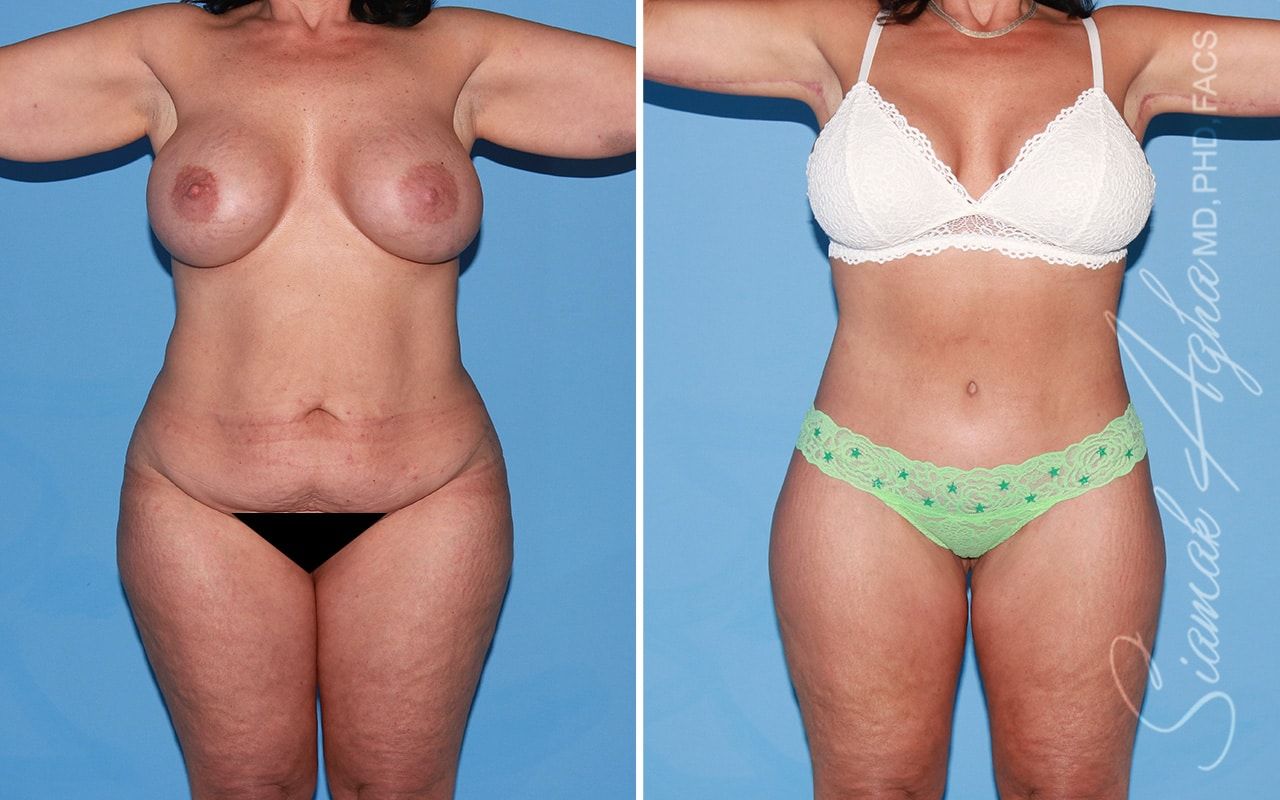 Total Body Lift Before & After