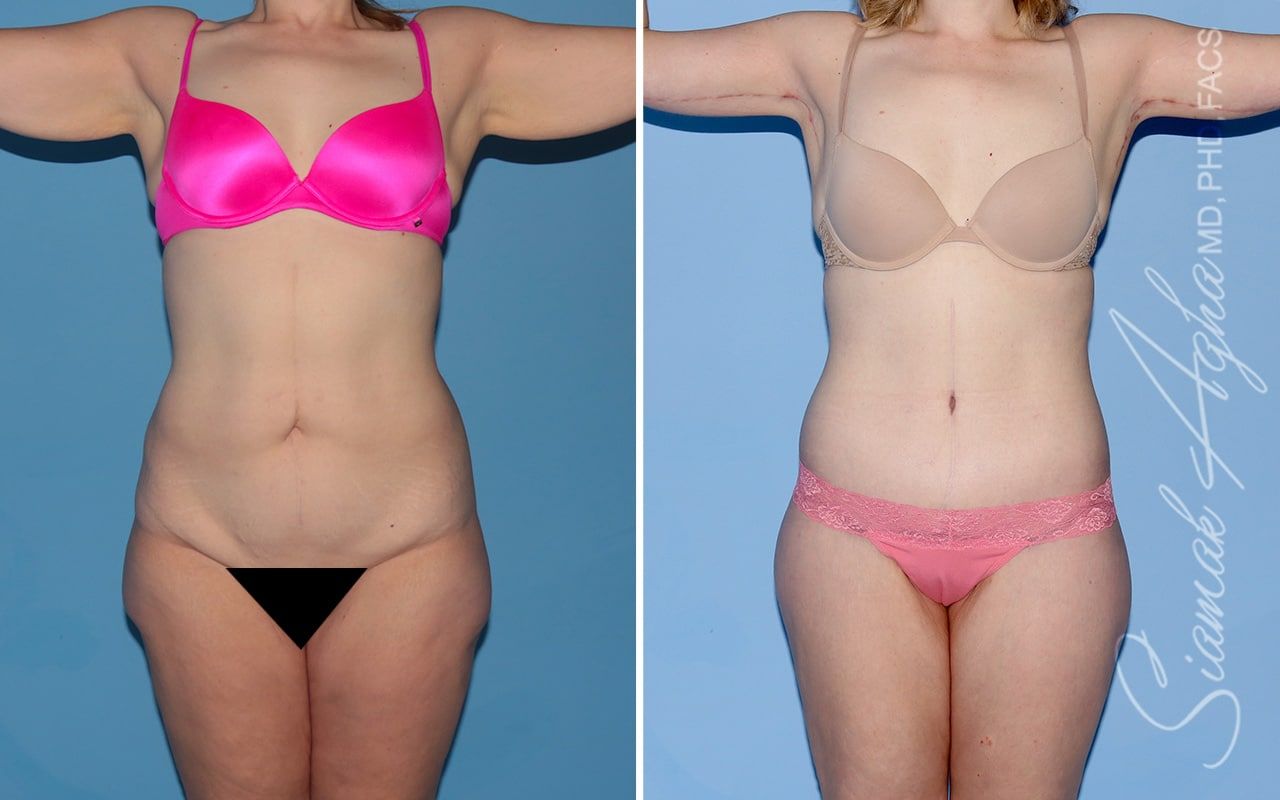 Total Body Lift Before & After