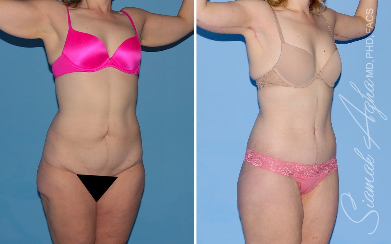 Total Body Lift Before & After
