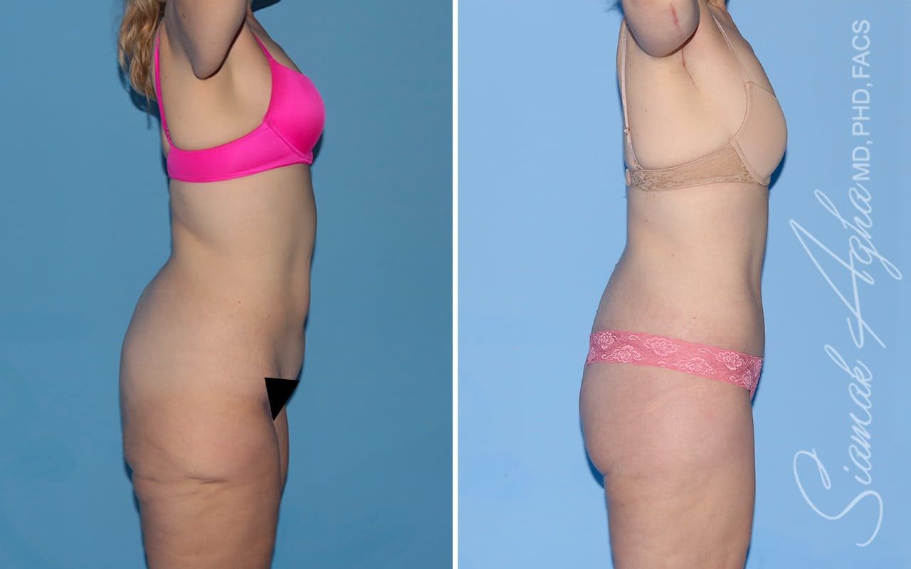 Total Body Lift Before & After