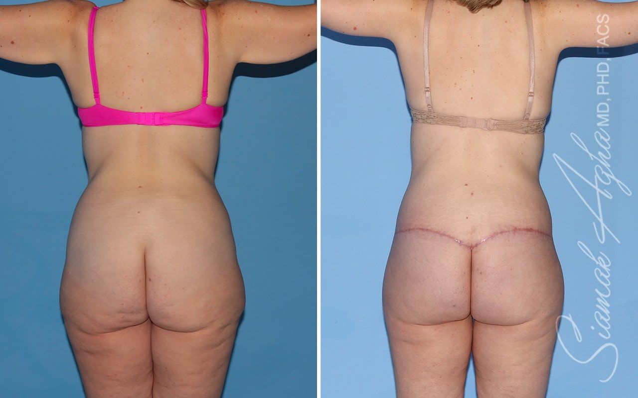 Total Body Lift Before & After