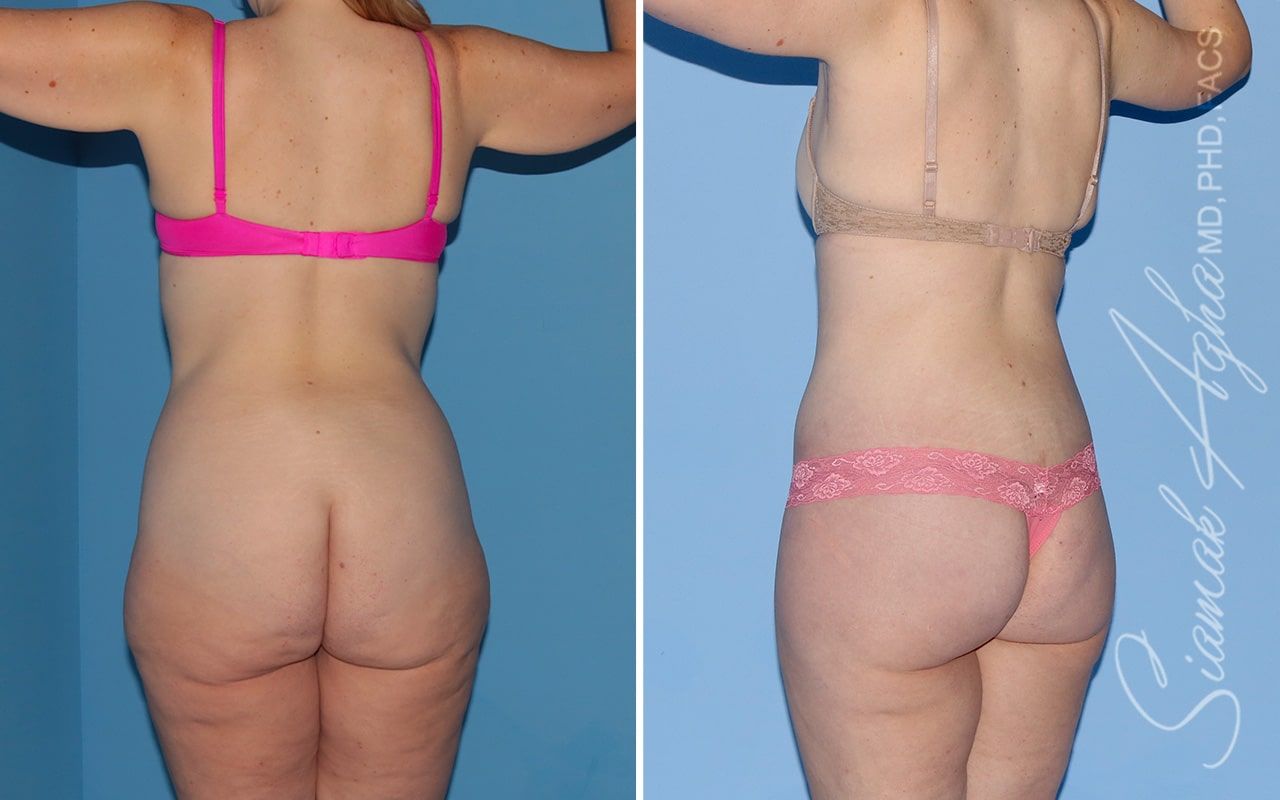 Total Body Lift Before & After