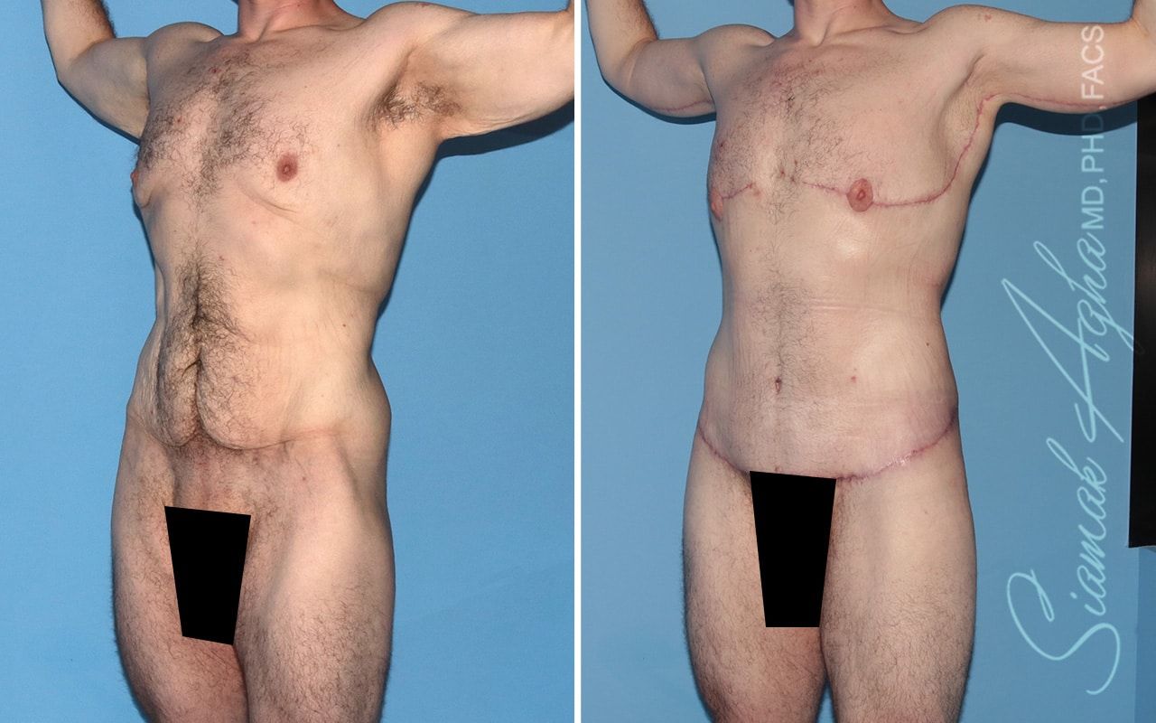 Total Body Lift Before & After