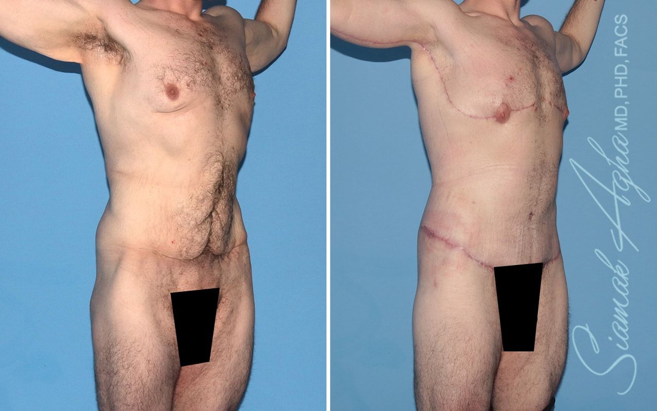 Total Body Lift Before & After