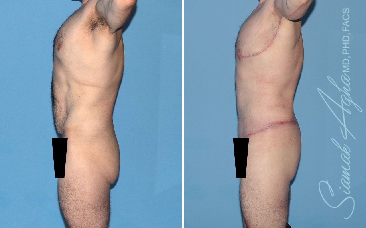 Total Body Lift Before & After