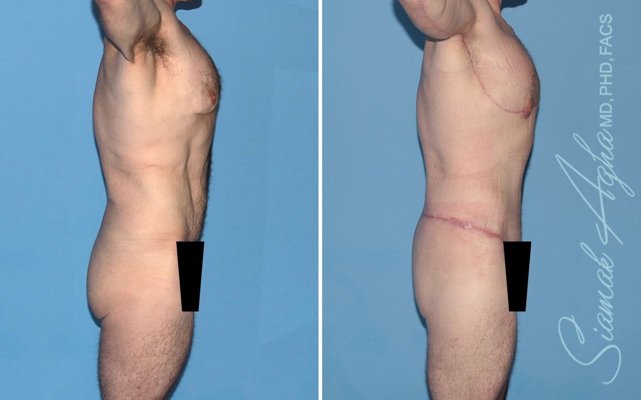 Total Body Lift Before & After