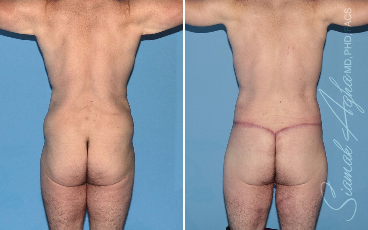 Total Body Lift Before & After