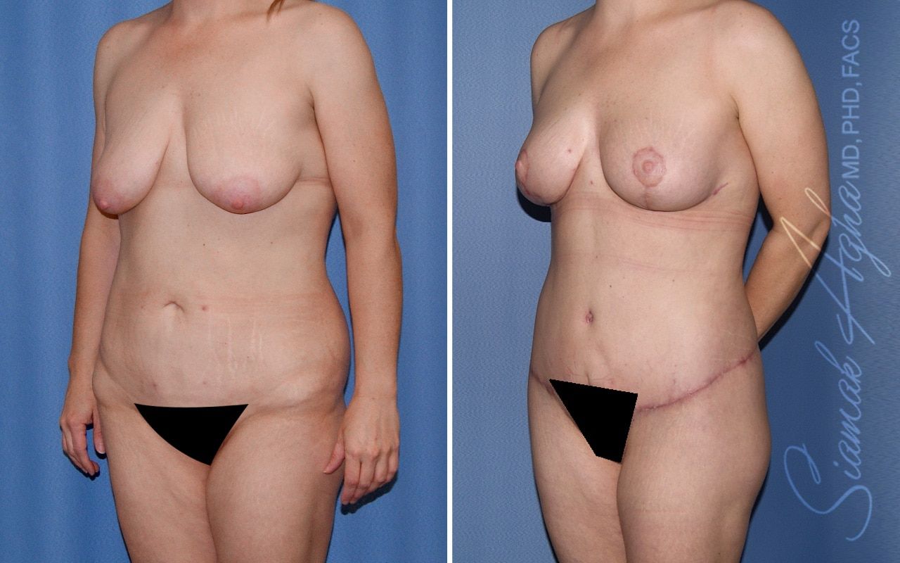 Total Body Lift Before & After