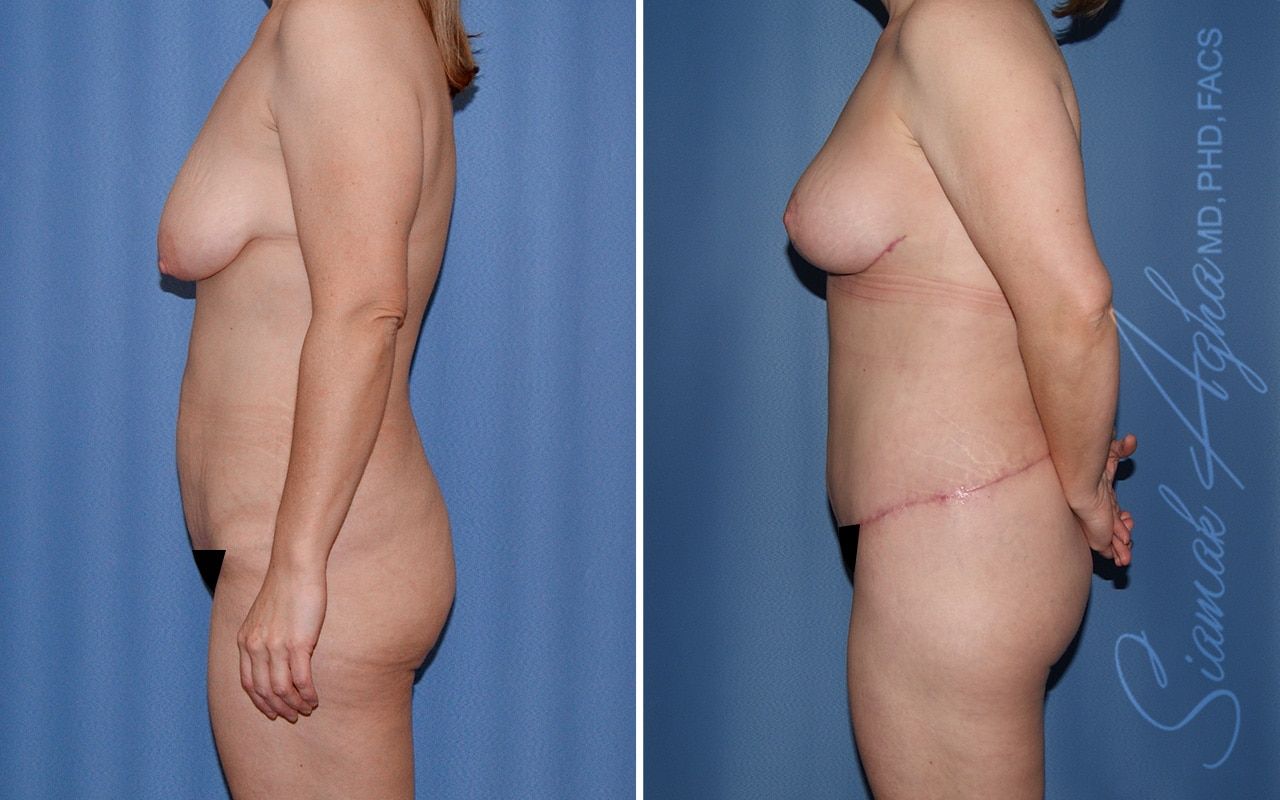 Total Body Lift Before & After