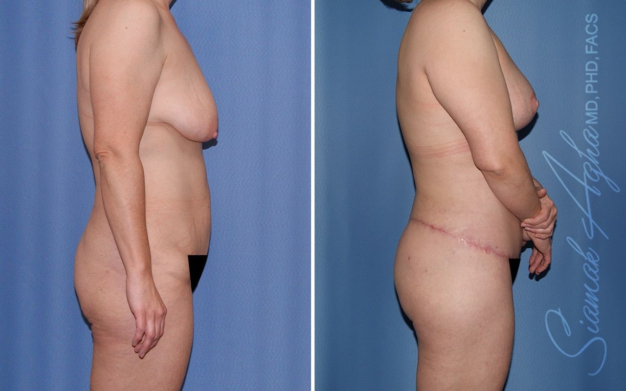 Total Body Lift Before & After