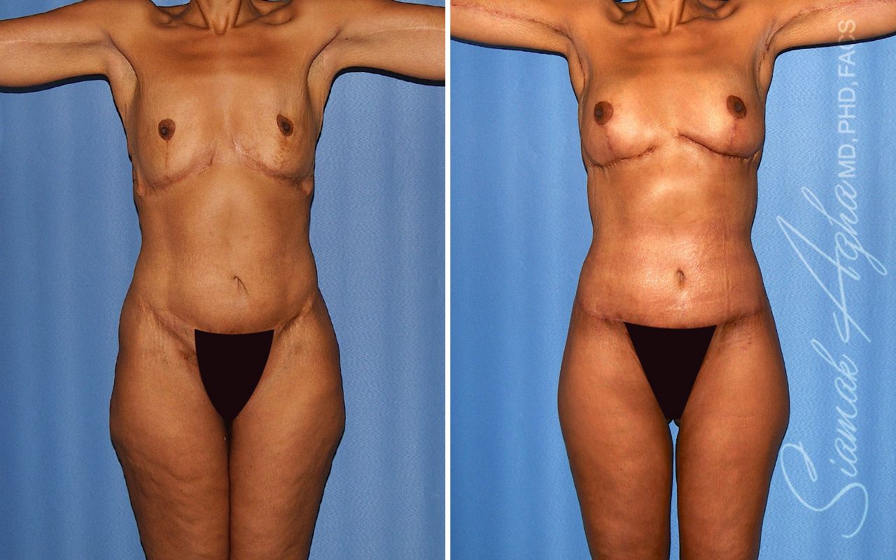 Total Body Lift Before & After