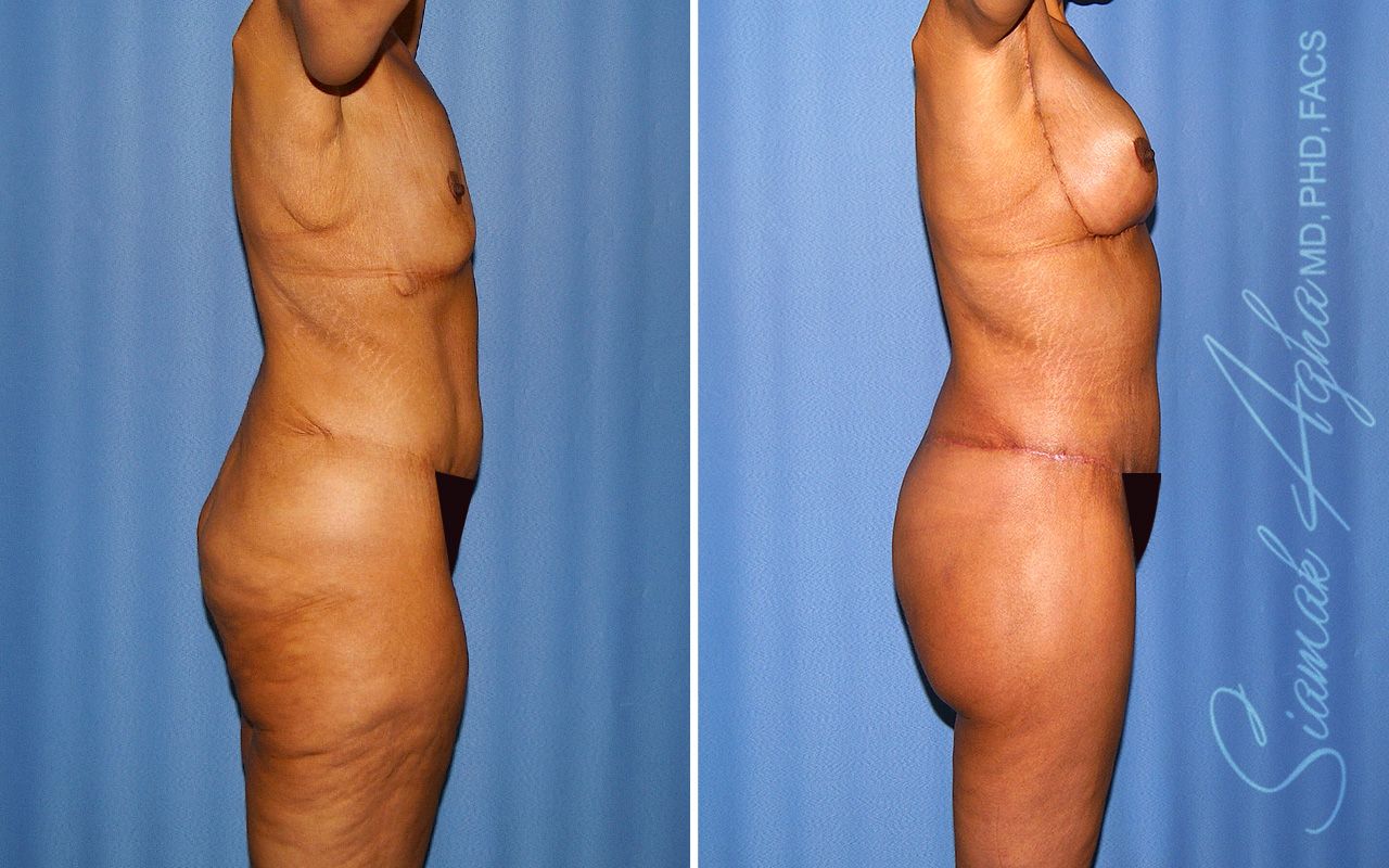 Total Body Lift Before & After