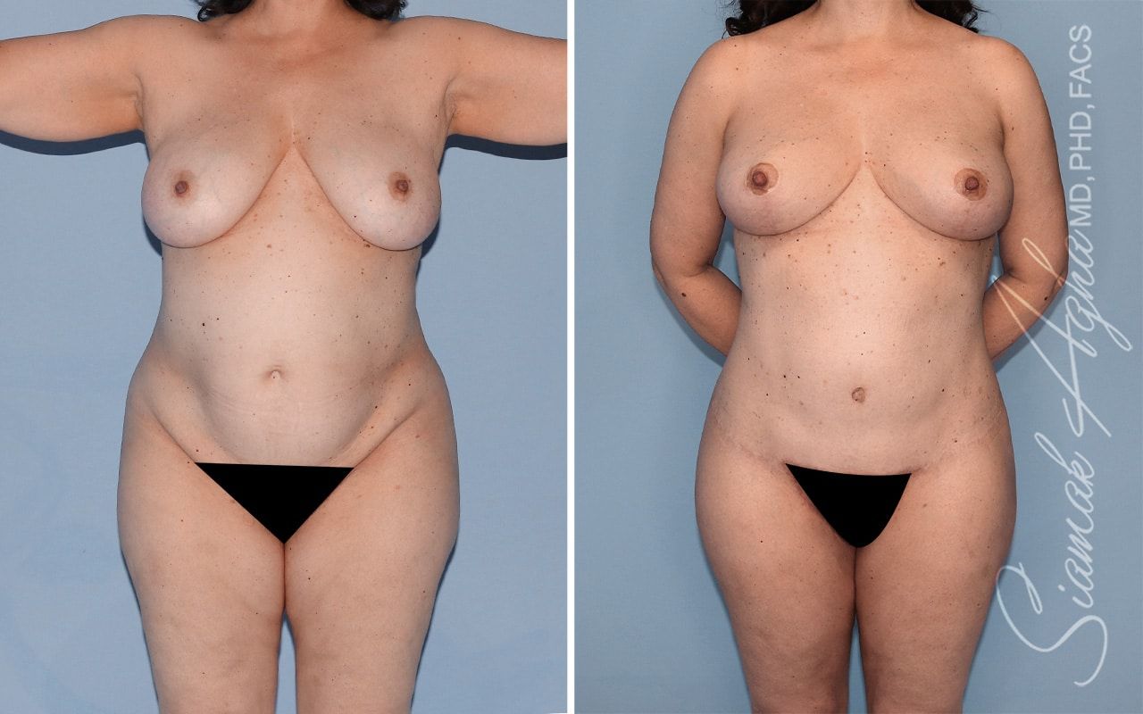 Total Body Lift Before & After
