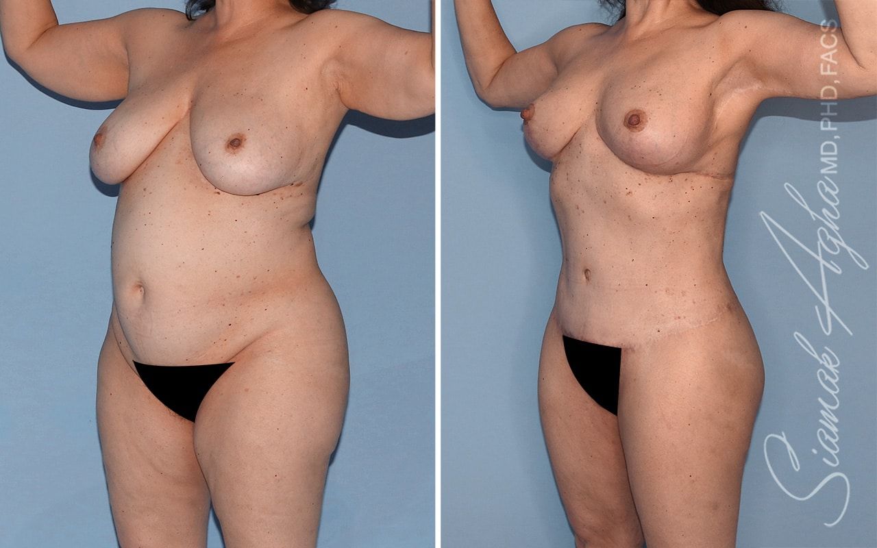 Total Body Lift Before & After