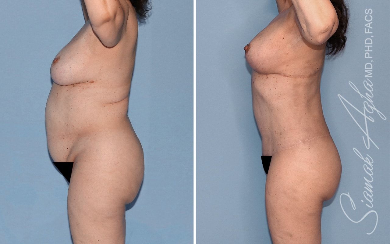 Total Body Lift Before & After