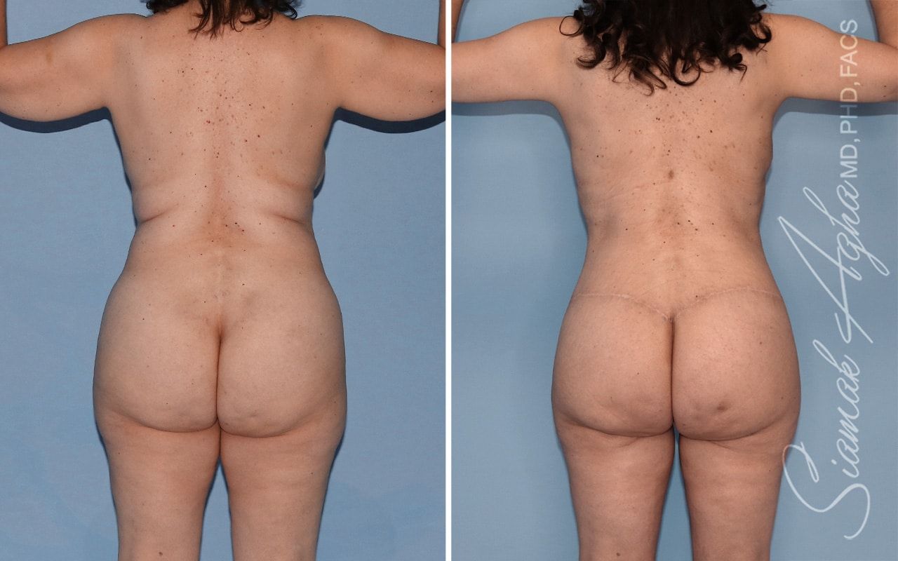 Total Body Lift Before & After
