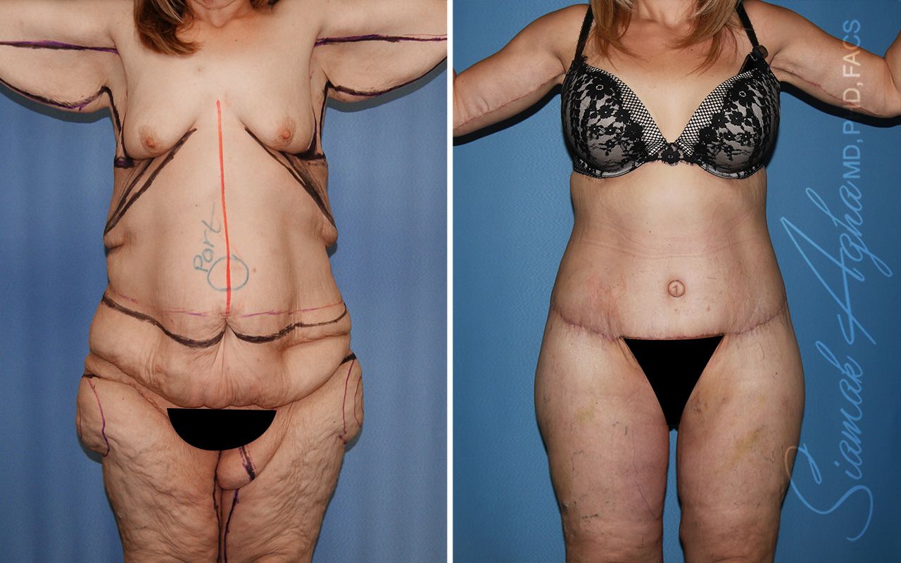 Total Body Lift Before & After