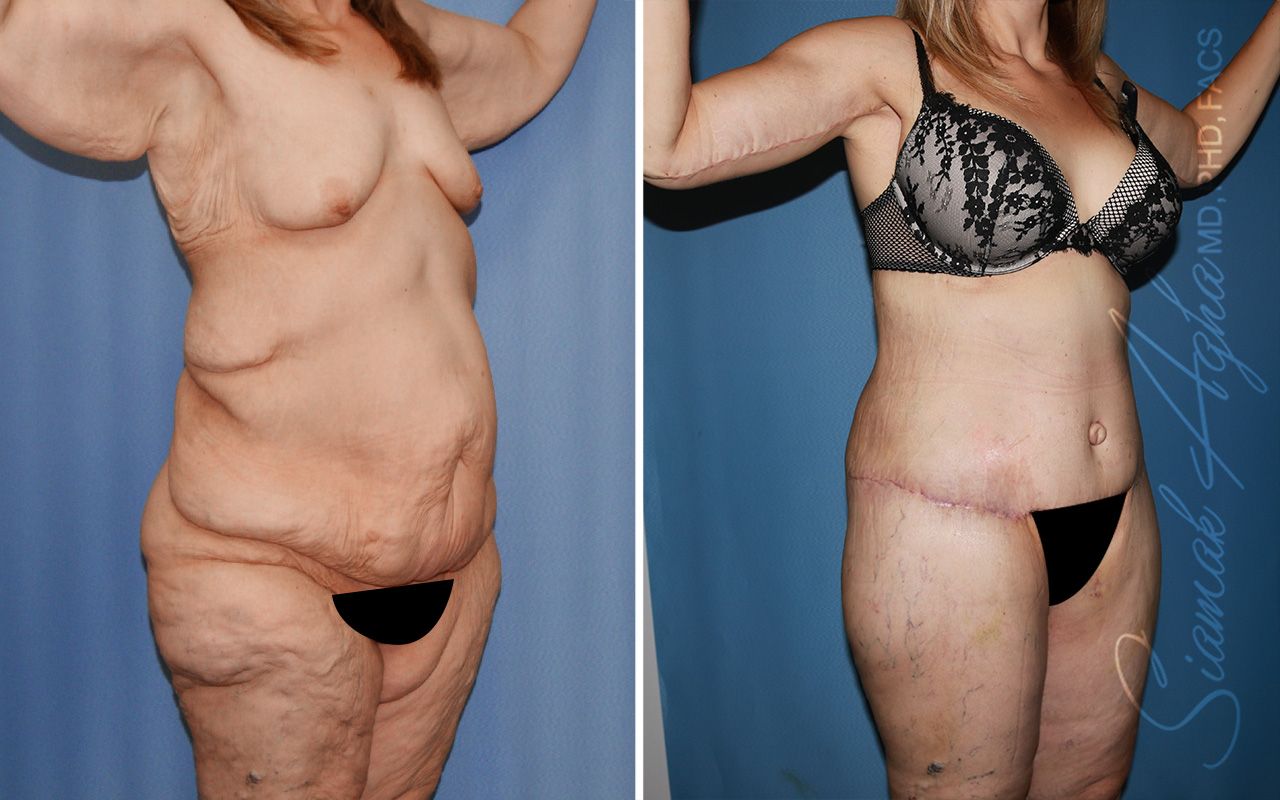 Total Body Lift Before & After