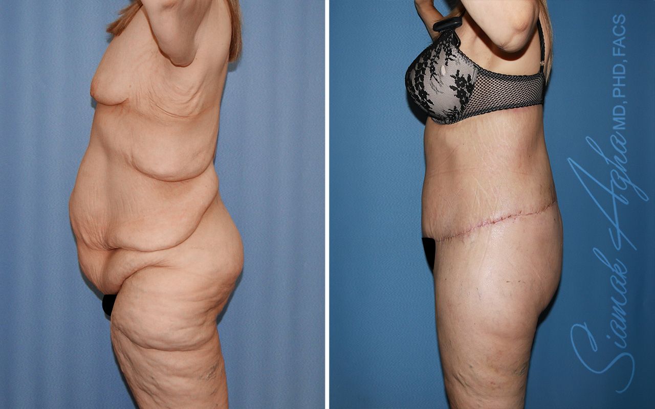 Total Body Lift Before & After