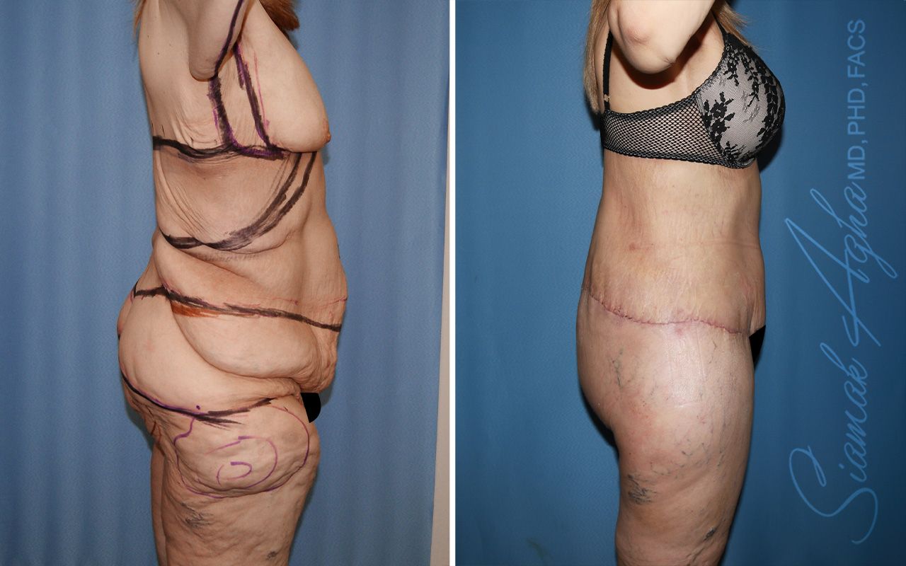 Total Body Lift Before & After