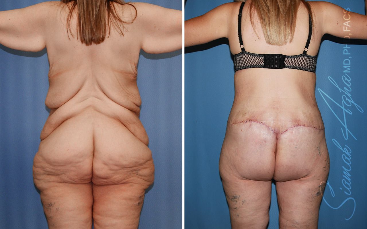 Total Body Lift Before & After