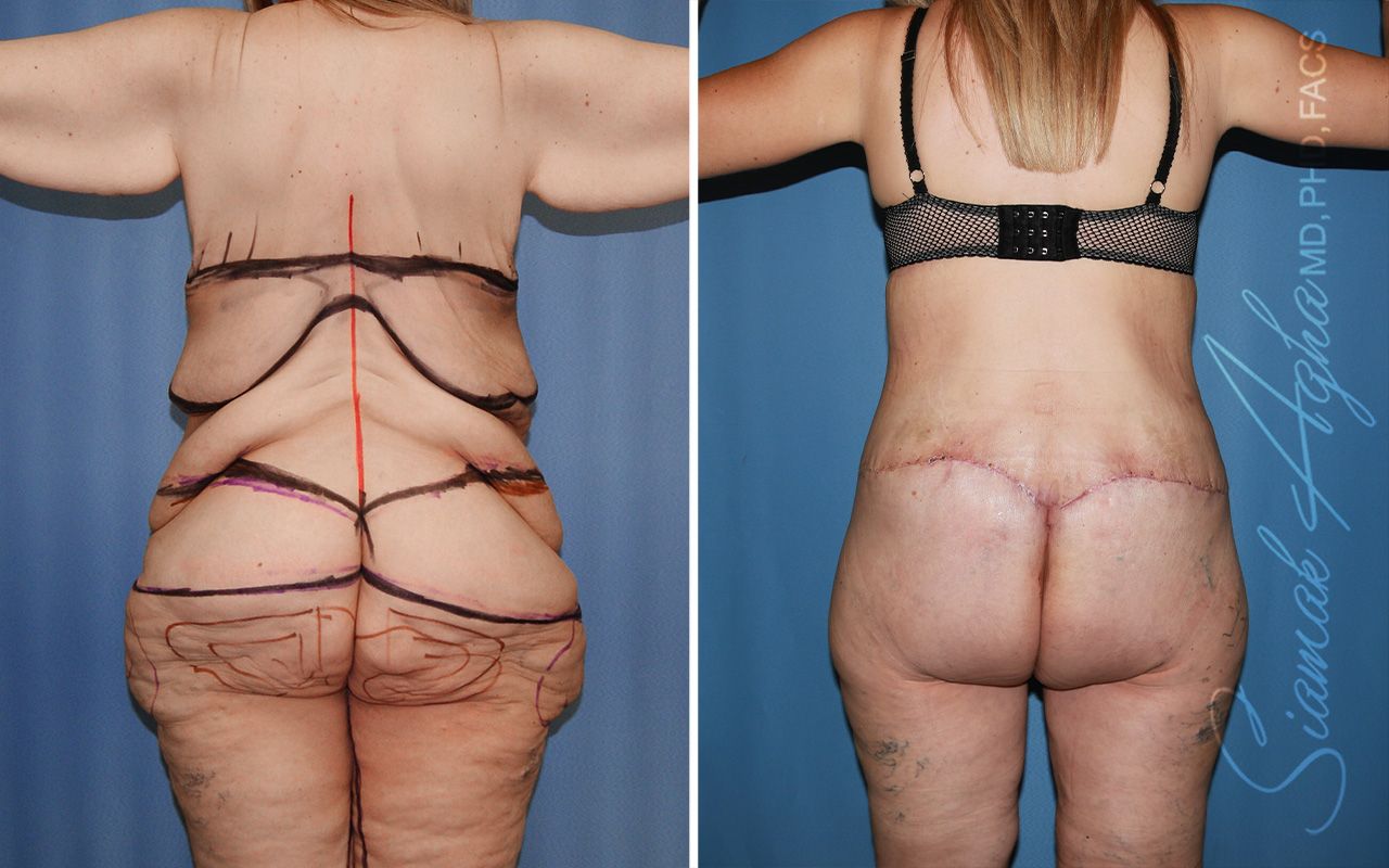 Total Body Lift Before & After