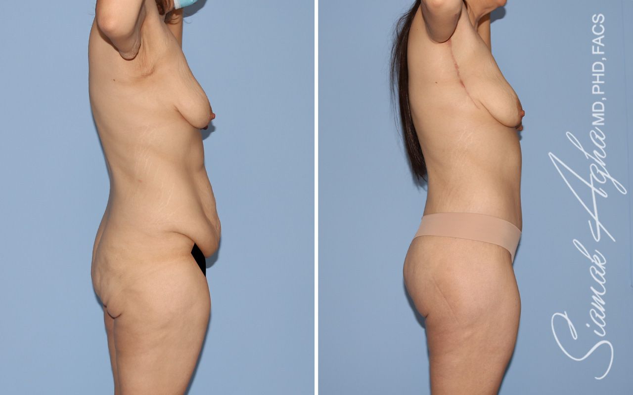 Total Body Lift Before & After