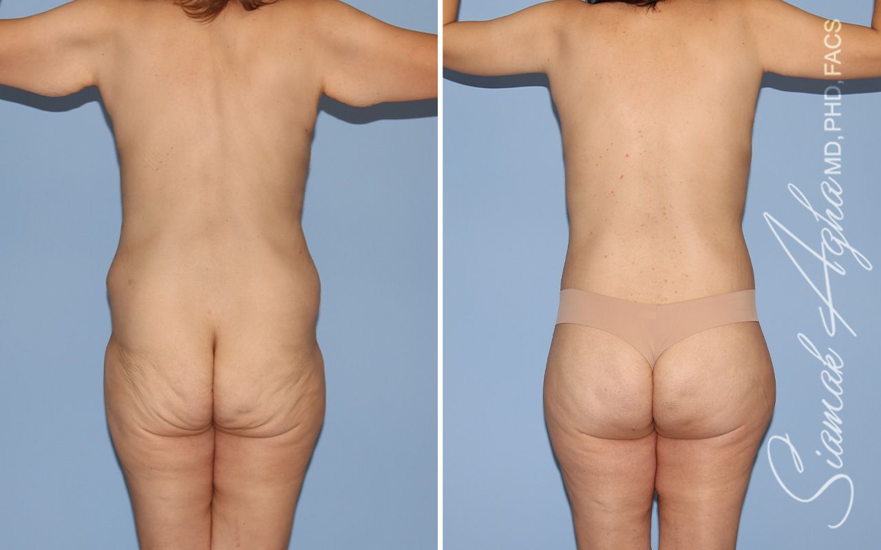 Total Body Lift Before & After