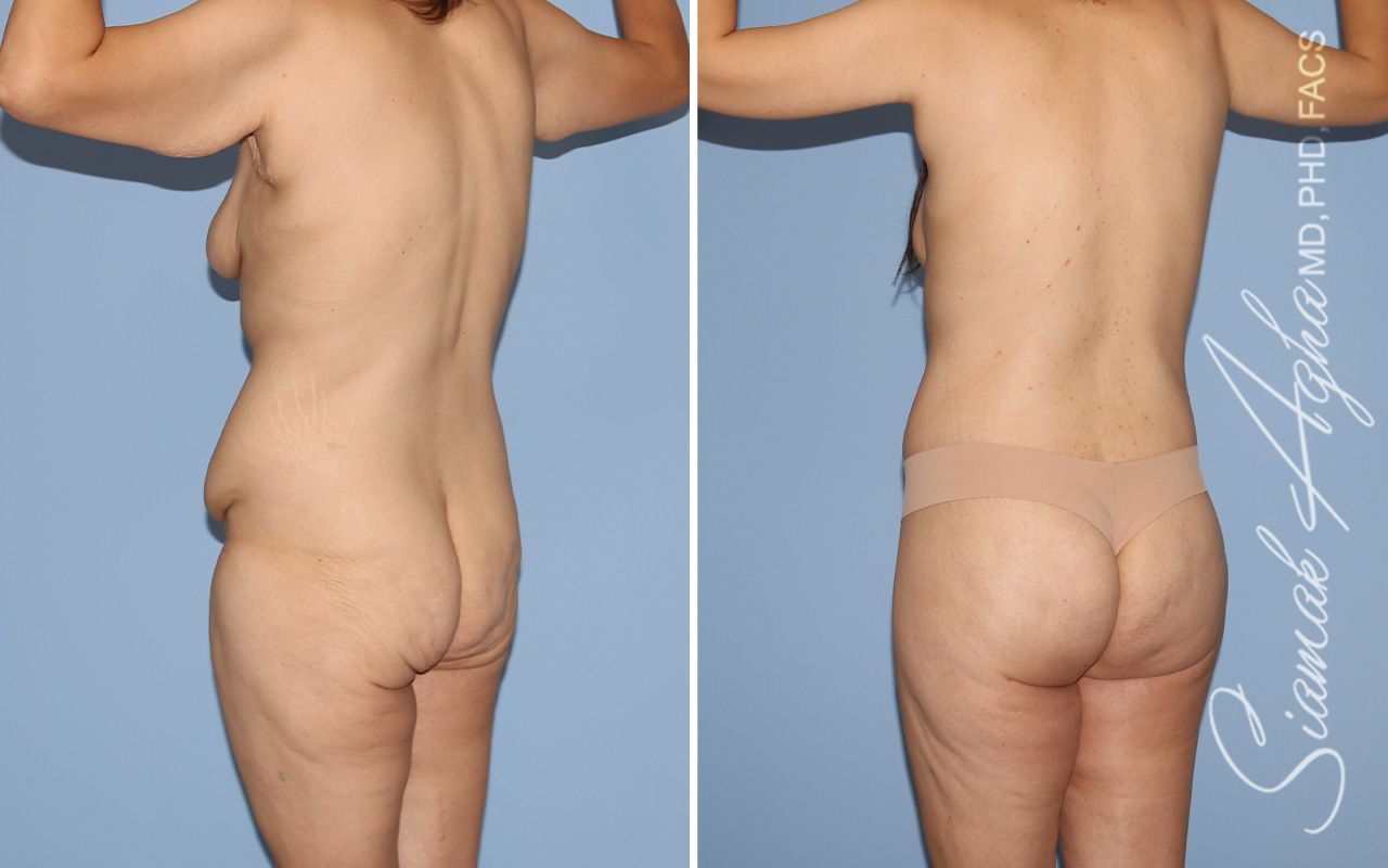 Total Body Lift Before & After