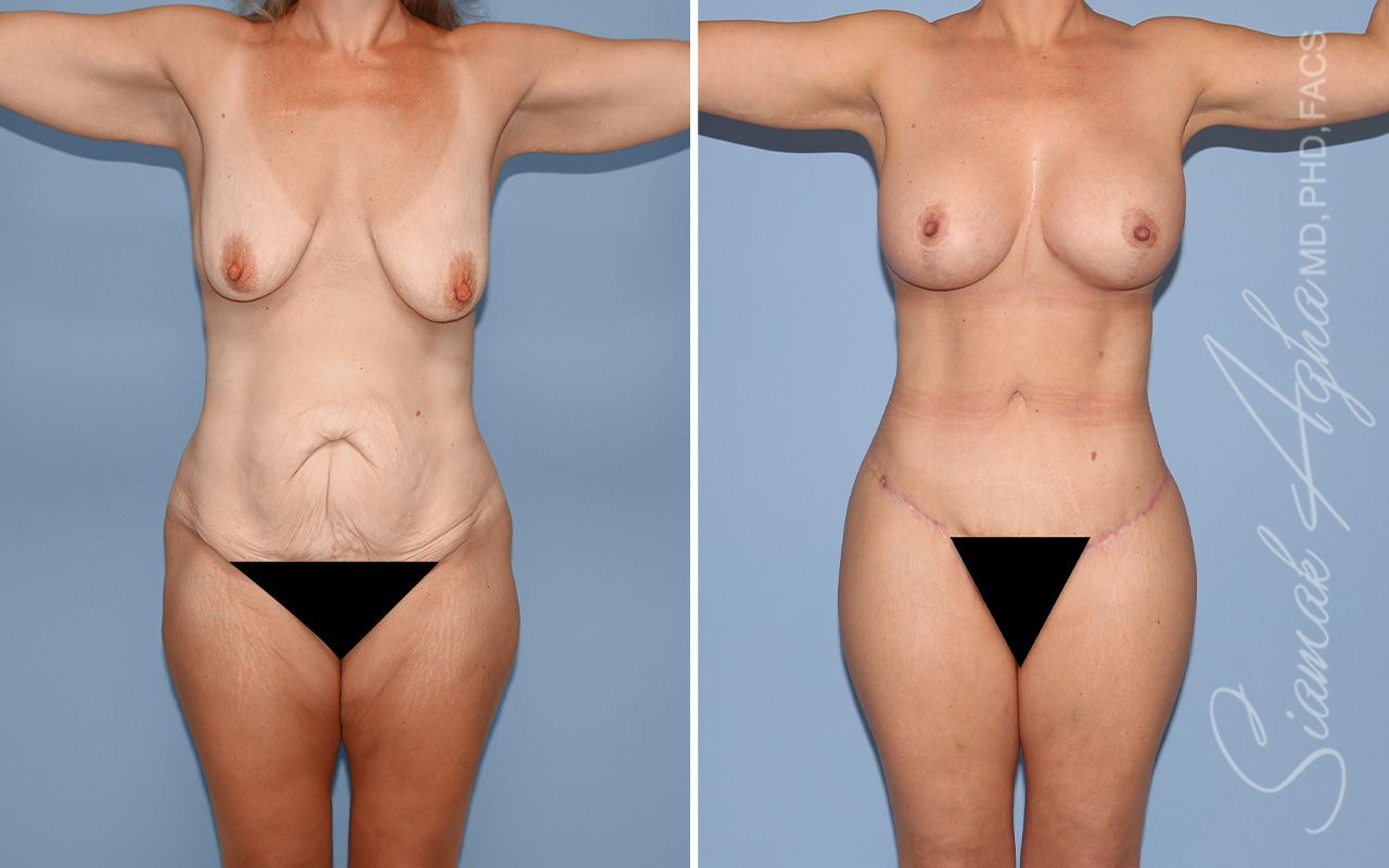 Total Body Lift Before & After