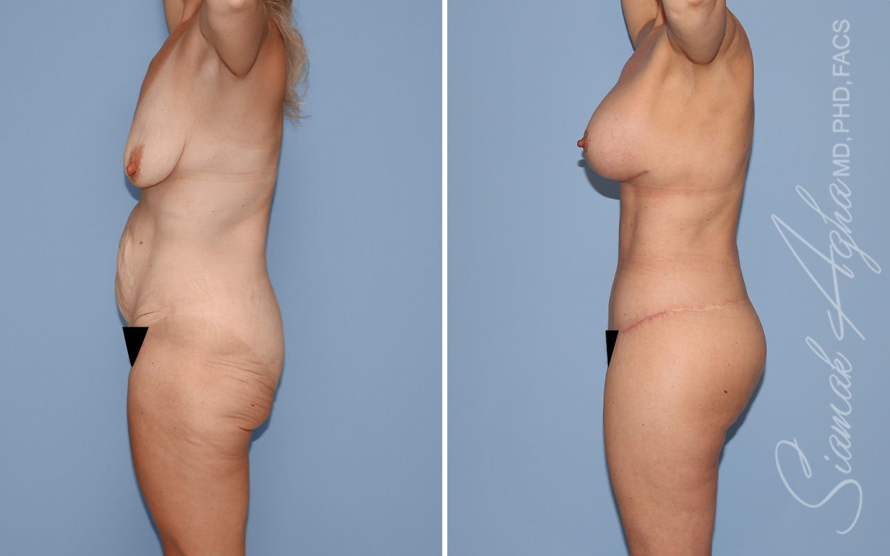 Total Body Lift Before & After