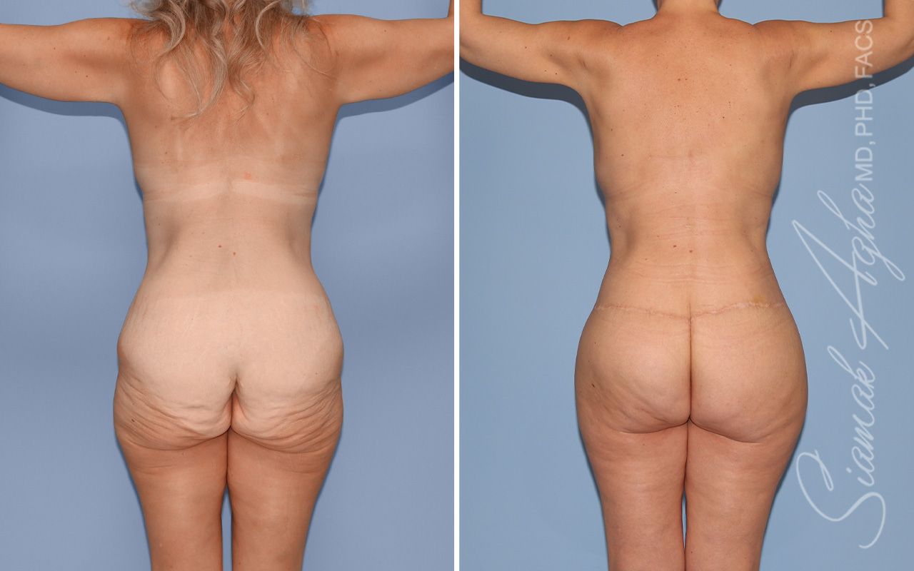 Total Body Lift Before & After