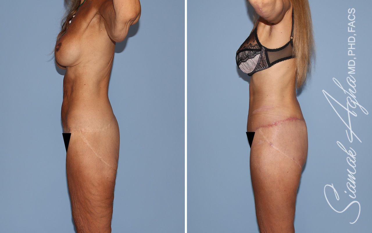 Total Body Lift Before & After