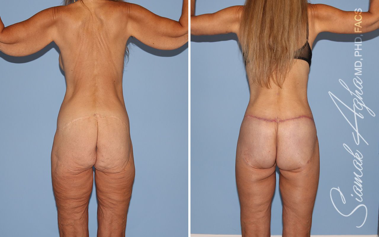Total Body Lift Before & After