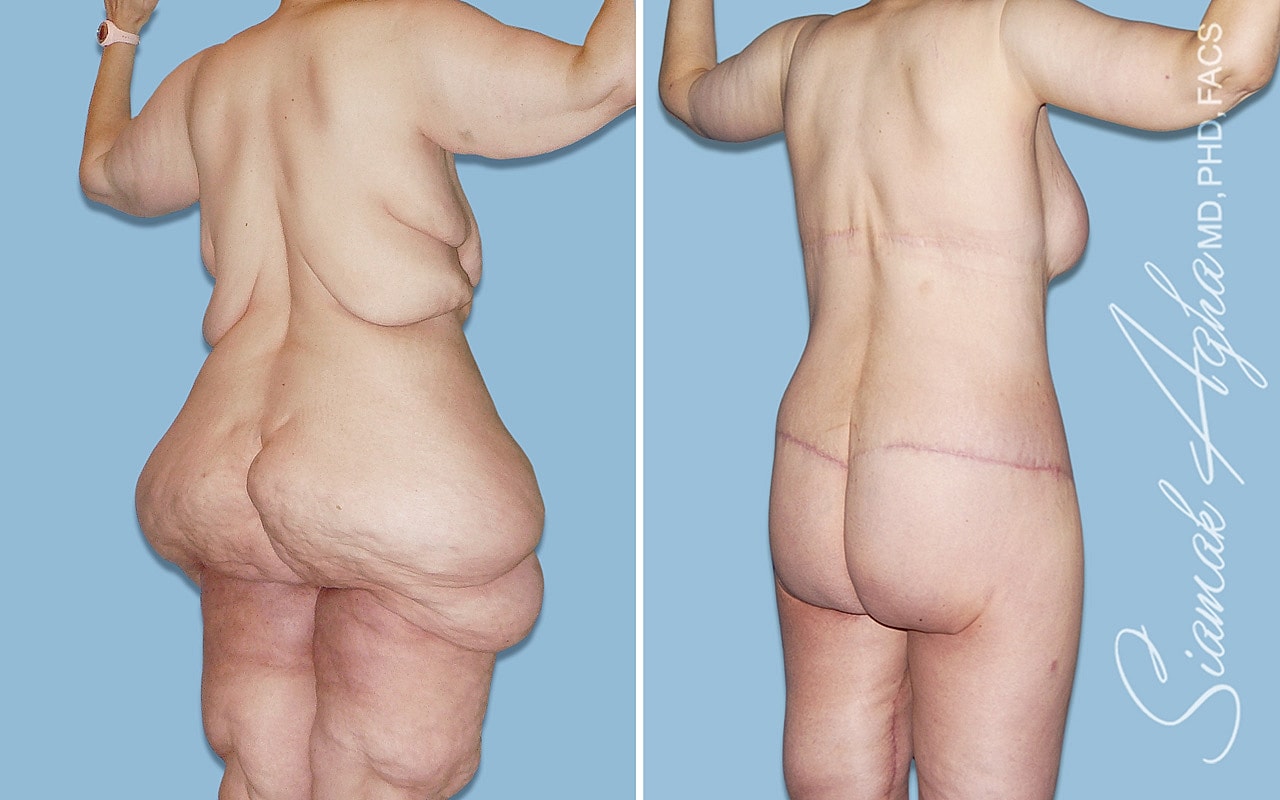 Before and after body contouring procedure.