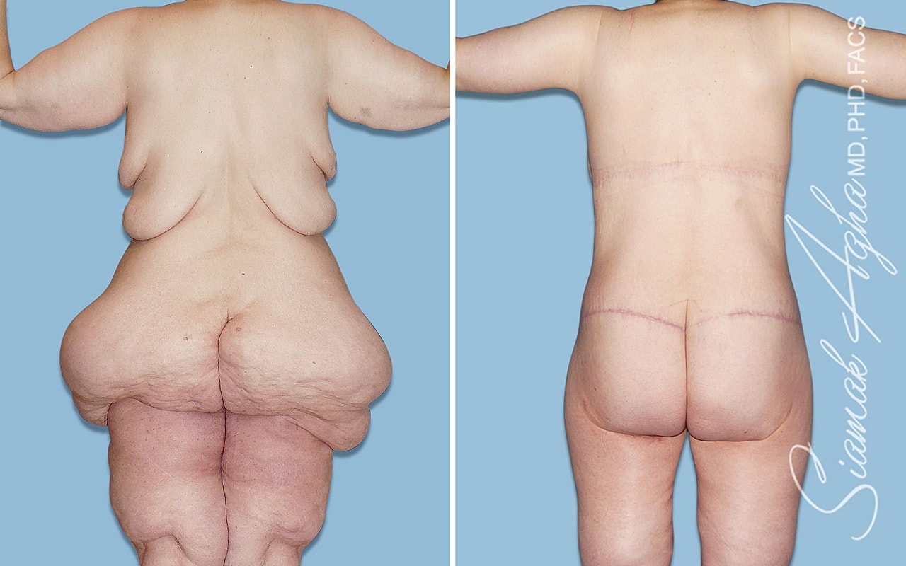 Before and after body contouring surgery results.