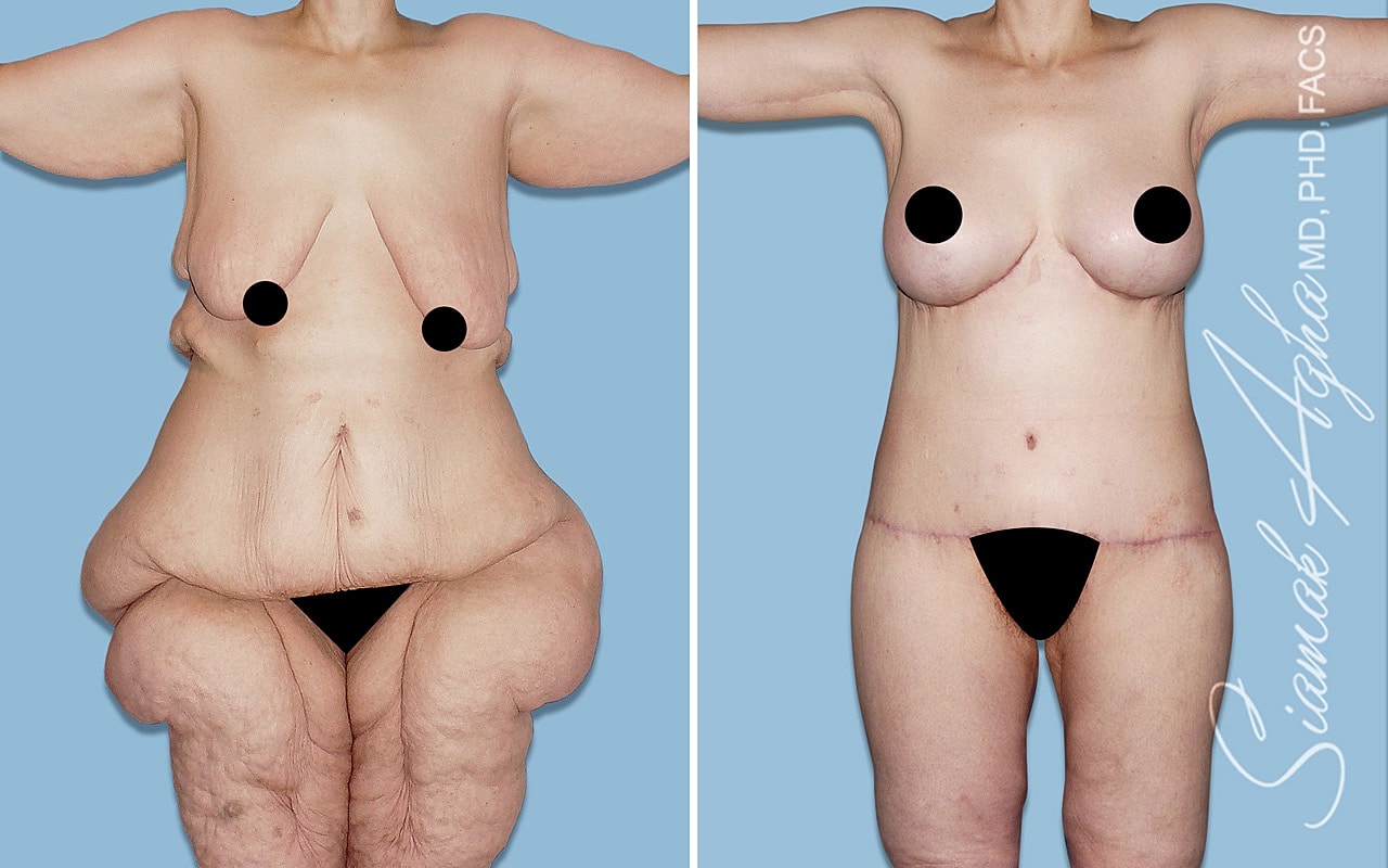 Before and after body contouring surgery results.