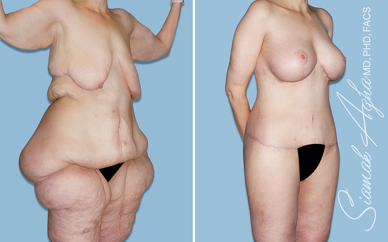 Before and after body contouring surgery comparison.