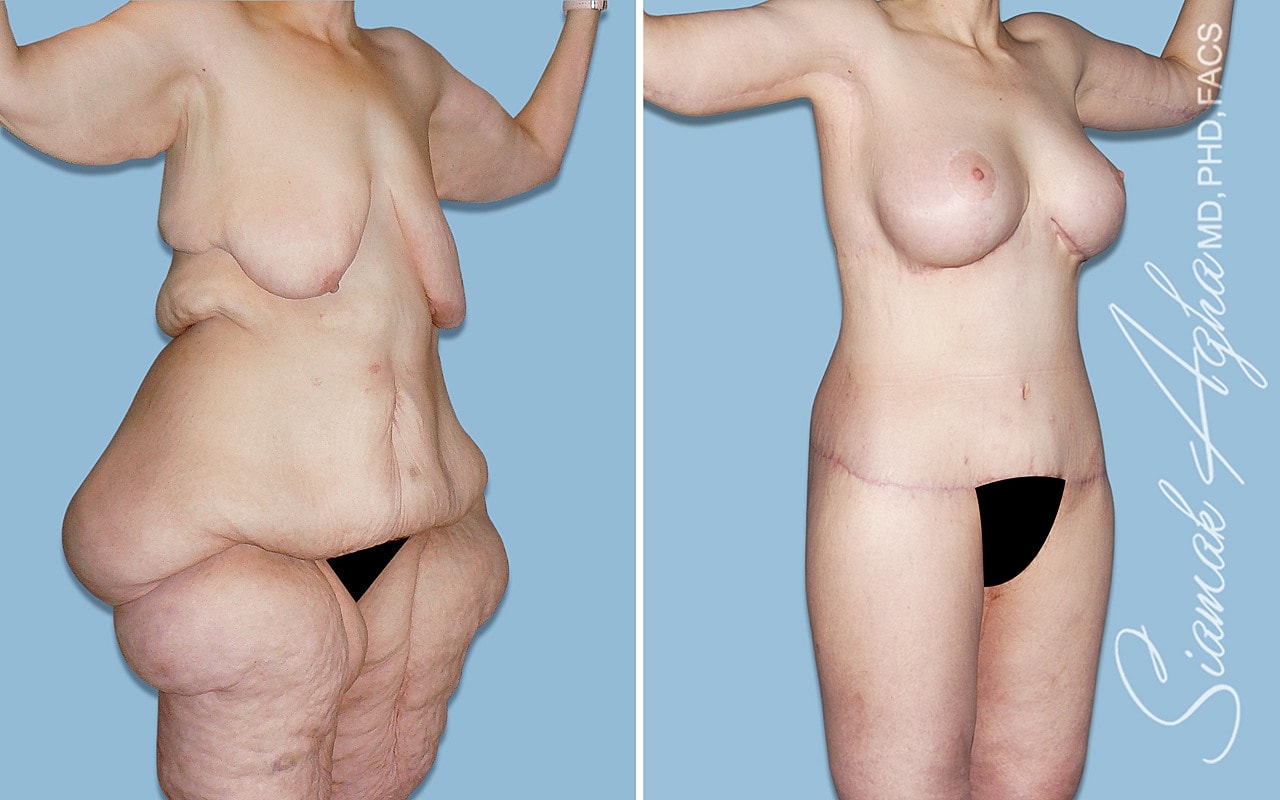 Before and after body contouring surgery results.