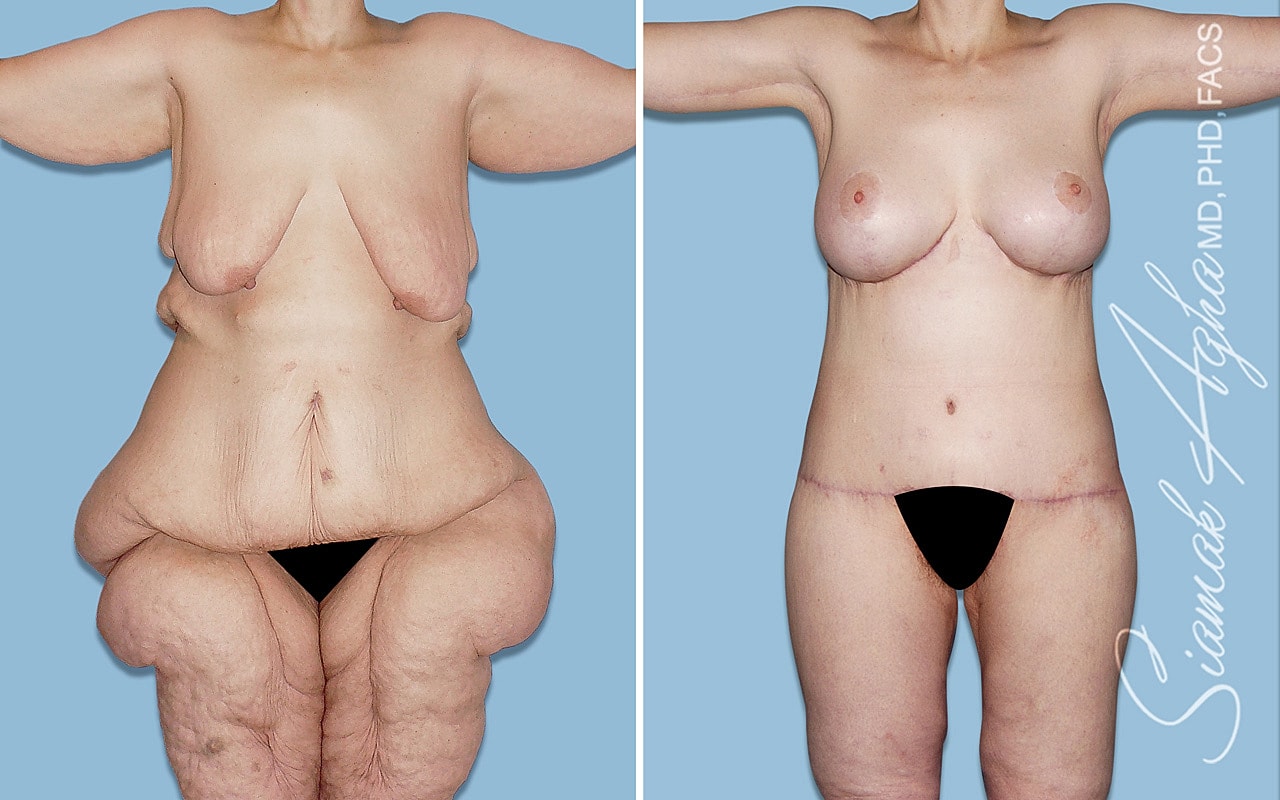 Before and after body transformation surgery.