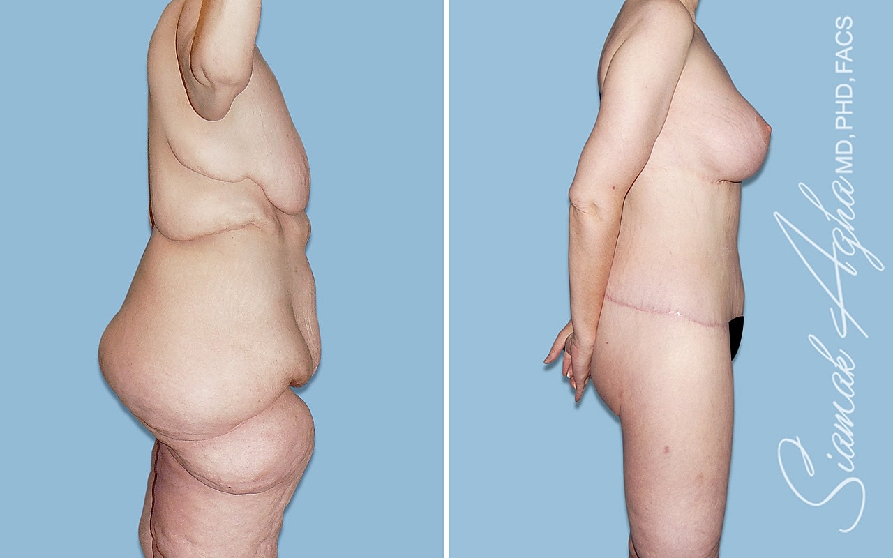Before and after body contouring surgery comparison.