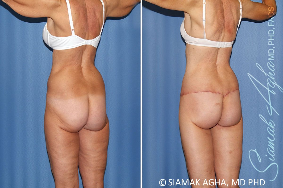Total Body Lift Before & After