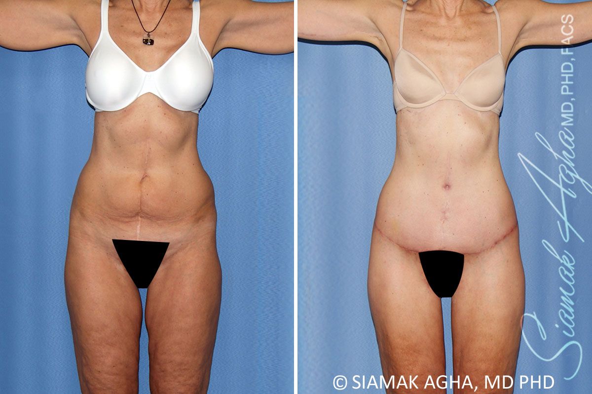 Total Body Lift Before & After