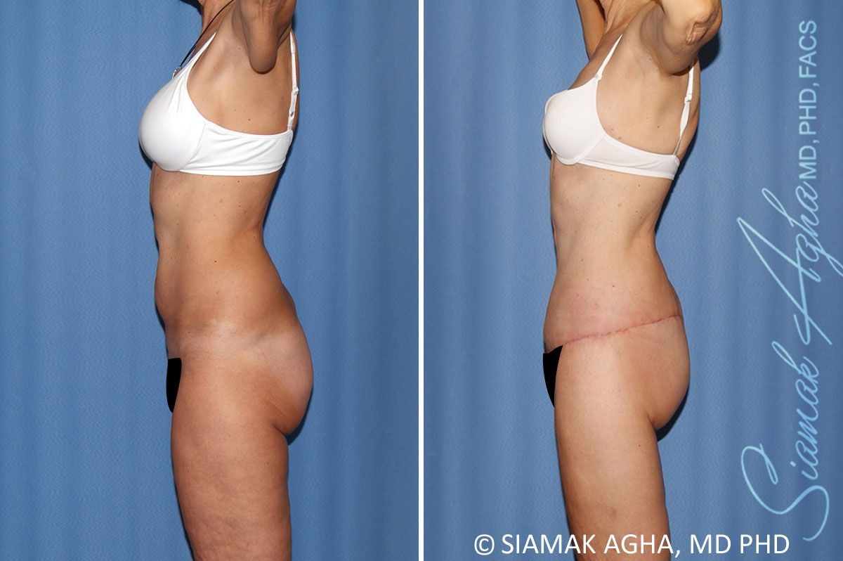 Total Body Lift Before & After