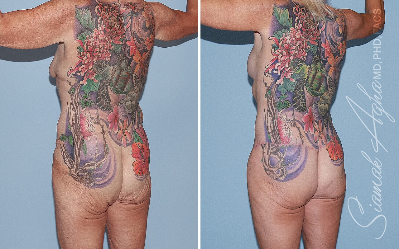 Total Body Lift Before & After