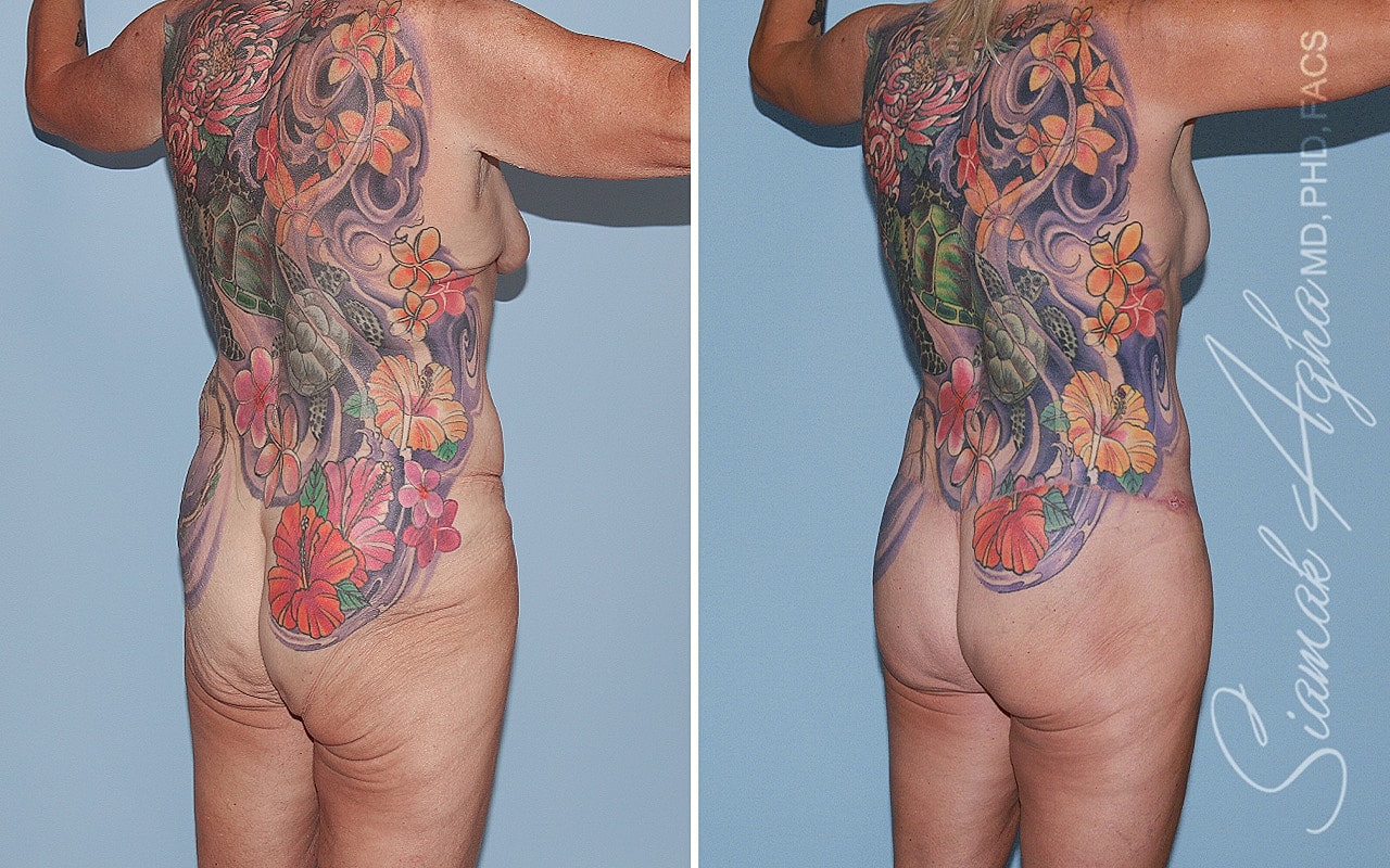 Total Body Lift Before & After