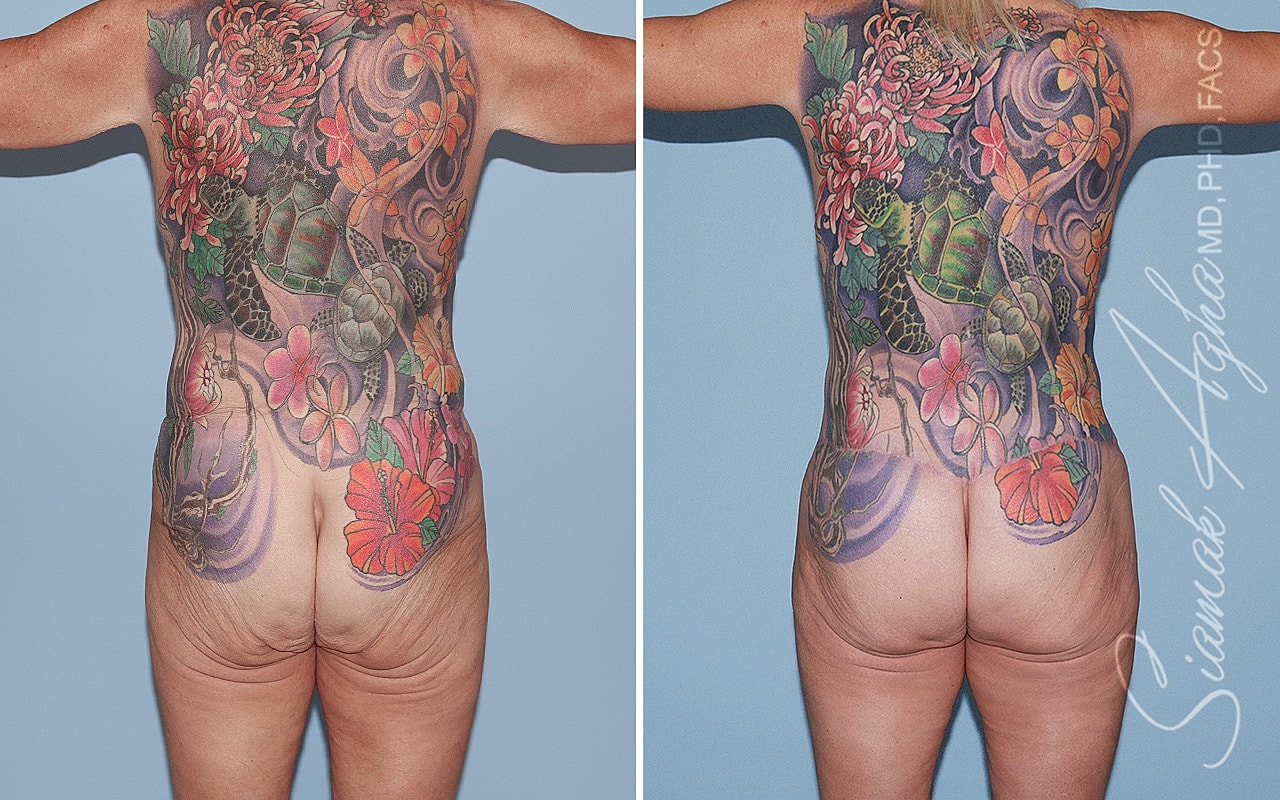 Total Body Lift Before & After