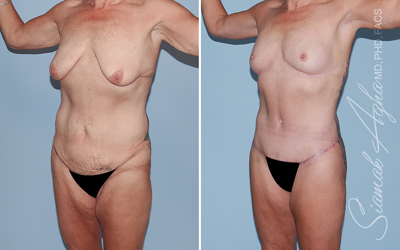 Total Body Lift Before & After