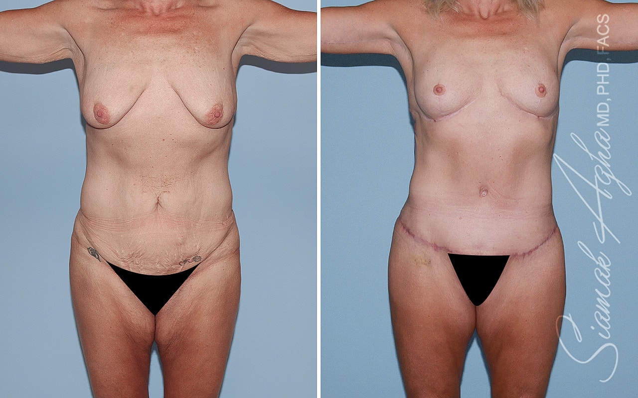Total Body Lift Before & After