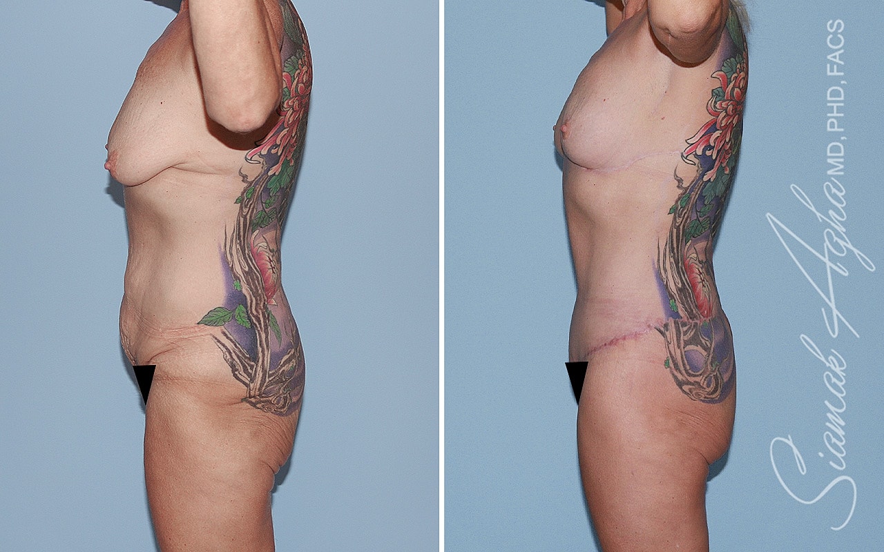 Total Body Lift Before & After